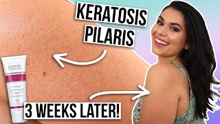 How Lactic Acid Works to Help Manage Dry Skin Associated with Keratosis Pilaris [upl. by Aissert]