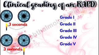 Pupil 4  Clinical grading of an RAPD  Marcus Gunn Pupil [upl. by Aneeh258]