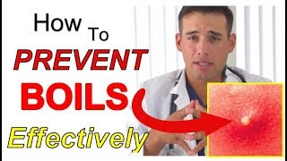 How to PREVENT Boils Effectively 4 STEPS  The Best Way to PREVENT Boils From Coming Back [upl. by Rutherfurd250]