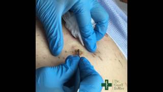 Removal of Seborrheic Keratosis [upl. by Marcile]