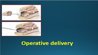 OPERATIVE DELIVERY  Instrumental deliveries Vacuum amp Forceps [upl. by Yager540]