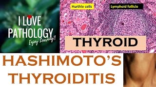 HASHIMOTOS THYROIDITIS Etiopathogenesis Morphology amp Complications [upl. by Lezti]