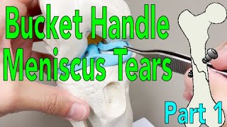 Bucket Handle Meniscus Tears  Part 1 [upl. by Krischer]